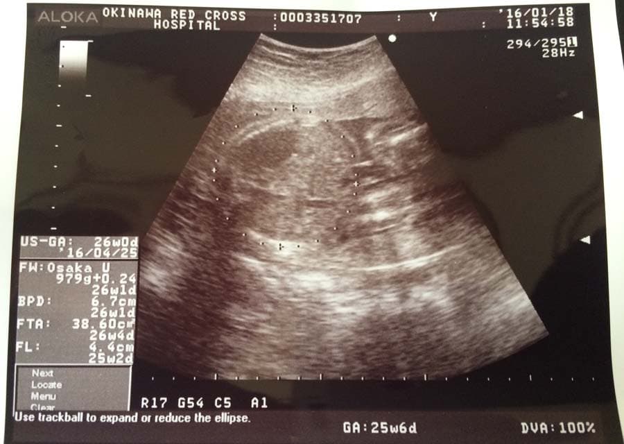 エコーでみた胎児